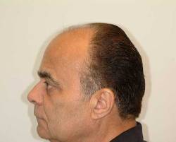 Before Image: Patient # 84213 - 