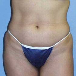 Before Image: Patient # 47300 - 