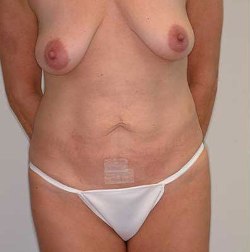 Before Image: Patient # 11966 - 