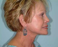 After Image: Patient # 21982 - 