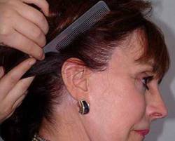 After Image: Patient # 99398 - 