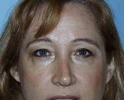 Before Image: Patient # 66570 - 