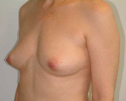 Before Image: Patient # 92893 - 