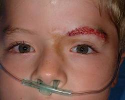 Before Image: Patient # 96913 - 