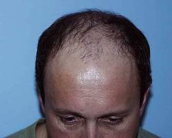 Before Image: Patient # 12498 - 