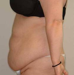 Before Image: Patient # 30262 - 