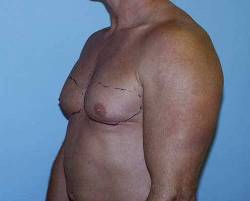 Before Image: Patient # 58006 - 