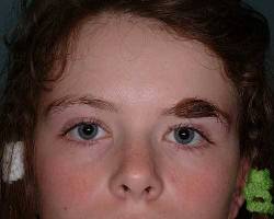 Before Image: Patient # 27429 - 