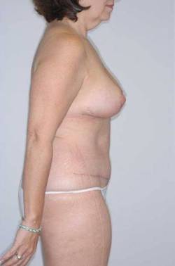 After Image: Patient # 35352 - 