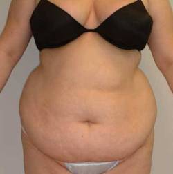 Before Image: Patient # 30262 - 