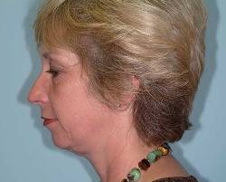 Before Image: Patient # 24341 - 