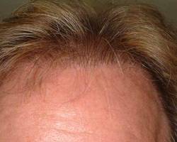 After Image: Patient # 10068 - 