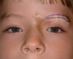 After Image: Patient # 96913 - 