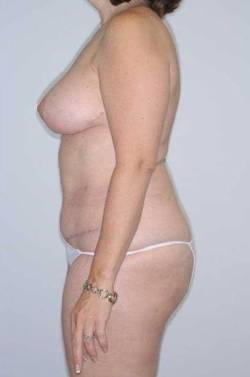 After Image: Patient # 58011 - 