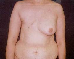 Before Image: Patient # 28709 - 