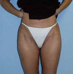 After Image: Patient # 37251 - 