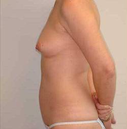 Before Image: Patient # 28345 - 