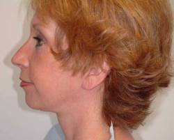 After Image: Patient # 24341 - 