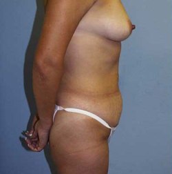 Before Image: Patient # 64178 - 