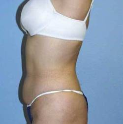 Before Image: Patient # 47300 - 
