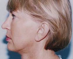 Before Image: Patient # 51186 - 