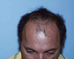 Before Image: Patient # 30986 - 