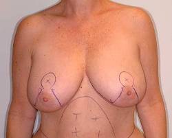 Before Image: Patient # 58331 - 