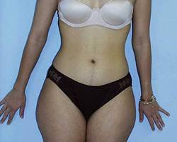 Before Image: Patient # 25322 - 