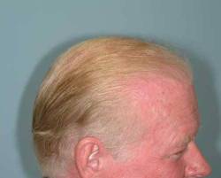 After Image: Patient # 56242 - 