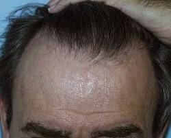 Before Image: Patient # 51467 - 