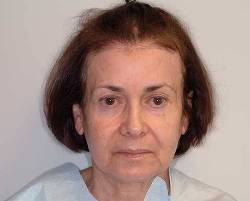 Before Image: Patient # 90484 - 