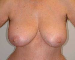 After Image: Patient # 38910 - 