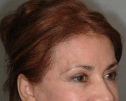 After Image: Patient # 33969 - 