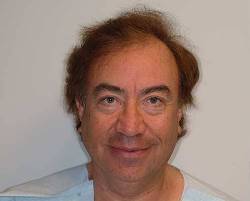 Before Image: Patient # 89786 - 
