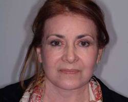 After Image: Patient # 33969 - 