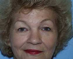 Before Image: Patient # 18554 - 