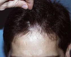 Before Image: Patient # 74924 - 