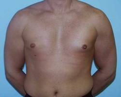 image of patient after gynecomastia male breast reduction procedure