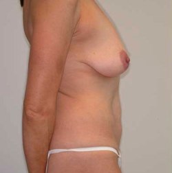 Before Image: Patient # 11966 - 