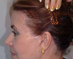 After Image: Patient # 90484 - 