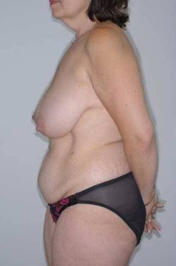 Before Image: Patient # 35352 - 