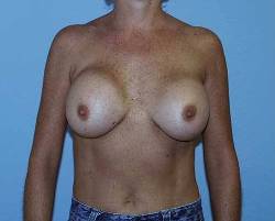 Before Image: Patient # 63900 - 