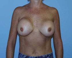 image of patient before their breast revision surgery by Dr. Barrera