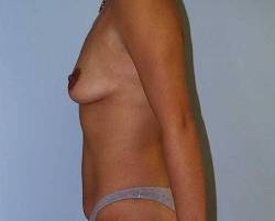 Before Image: Patient # 30745 - 