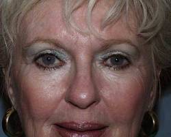 After Image: Patient # 72961 - 