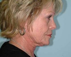 Before Image: Patient # 21982 - 