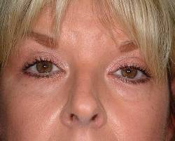 Before Image: Patient # 89880 - 