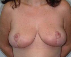 After Image: Patient # 45985 - 