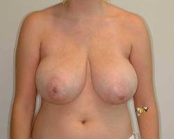 before image of patient who received a breast reduction by Dr. Barrera in Houston, TX