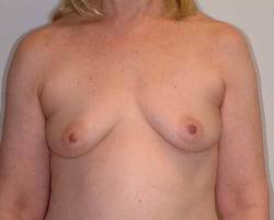 Before Image: Patient # 79152 - 